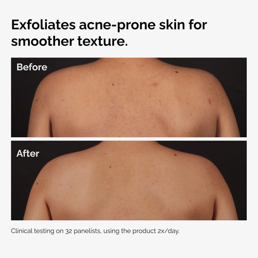 the-body-care-collection-s0 ord-salicylic-acid-body-serum-before-after-graphic-NA.jpg
