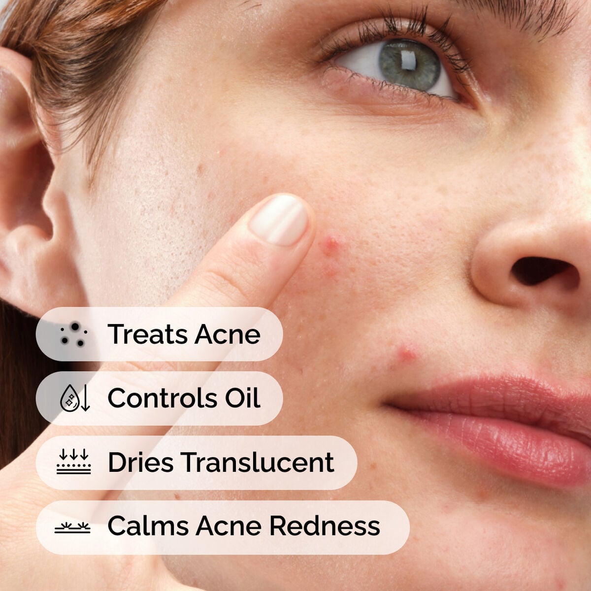 sulfur-10-powder-to-cream-concentrate-d1 ord-sulfur-10pct-powder-to-cream-concentrate-model-application-with-benefits-acne.jpg