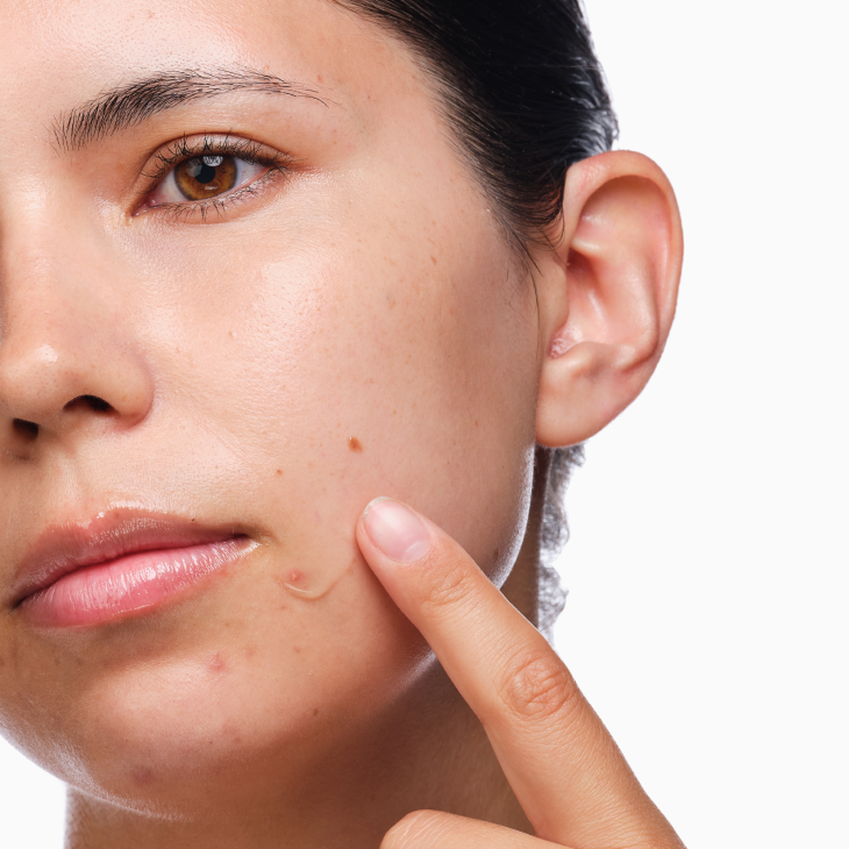 the-acne-set-w3 rdn-the-acne-set-application.png
